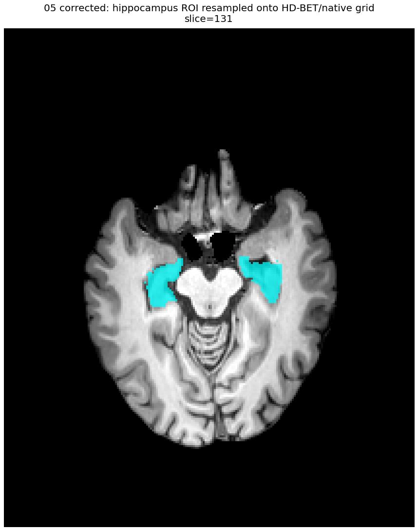 Hippocampus ROI overlay — affine corrected