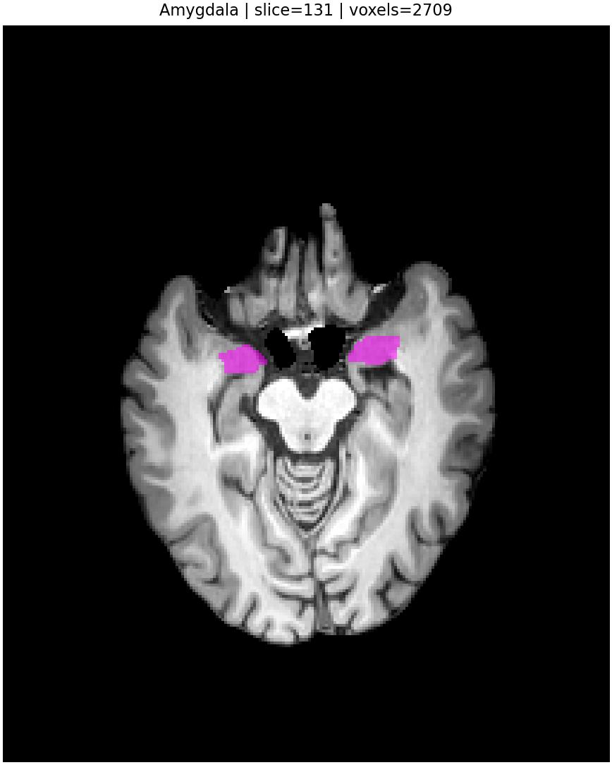 Amygdala overlay