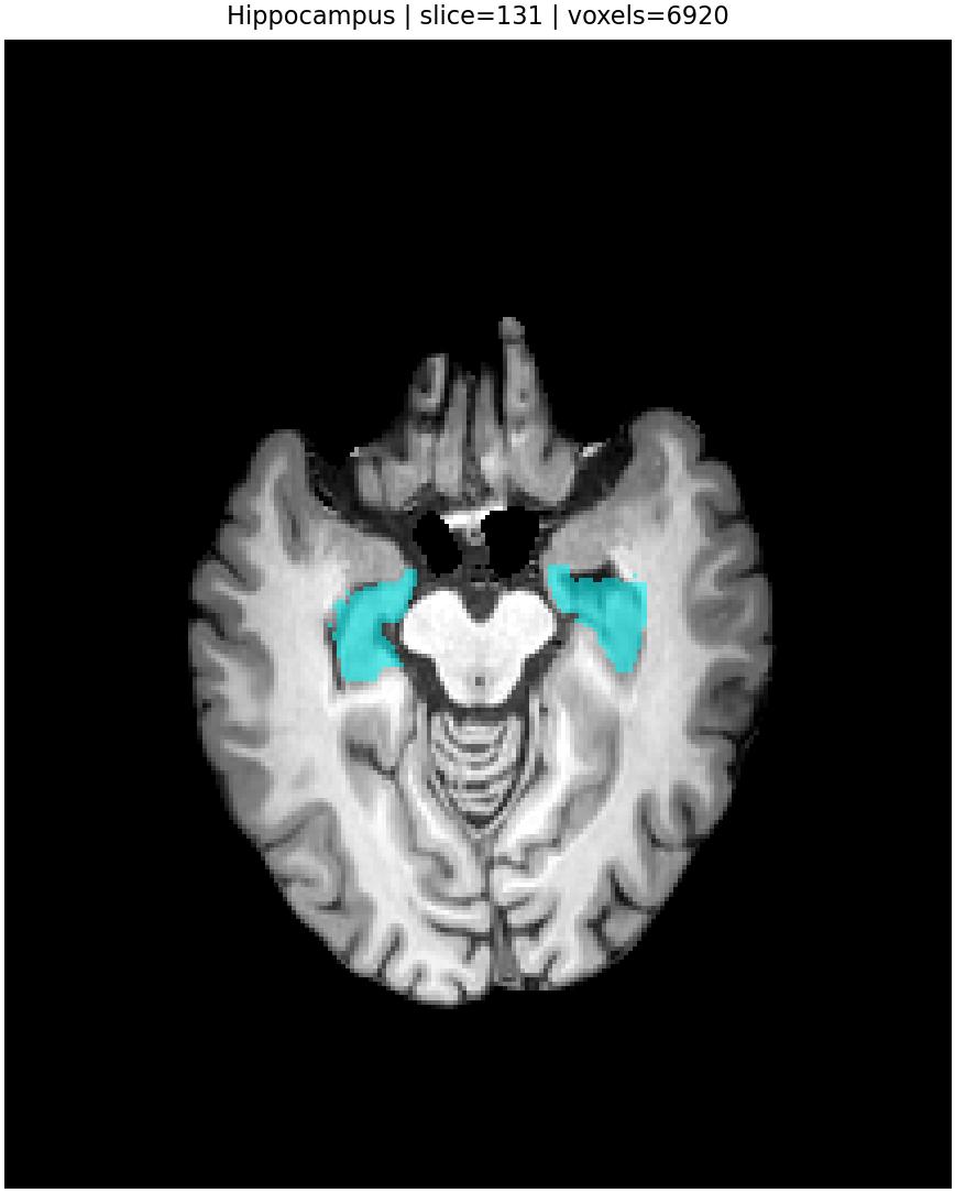 Hippocampus overlay