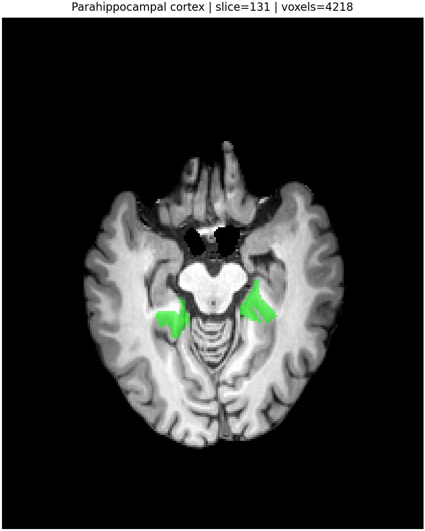 Parahippocampal cortex overlay