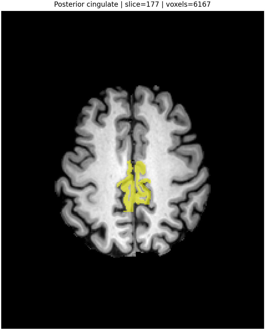 Posterior cingulate overlay
