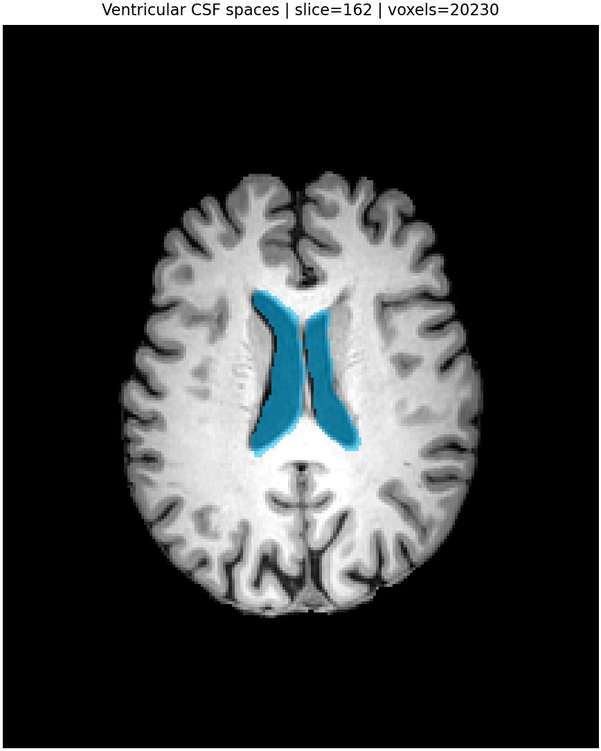 Ventricles overlay